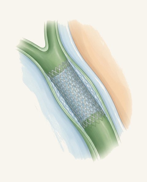 Soft anatomie illustratie van een metalen stent in de galweg